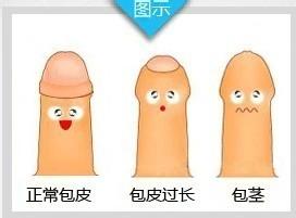 河池男性为什么会发生包茎