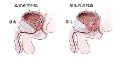 如何自查是不是患了前列腺增生呢？
