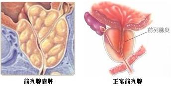导致前列腺囊肿的病因有什么?